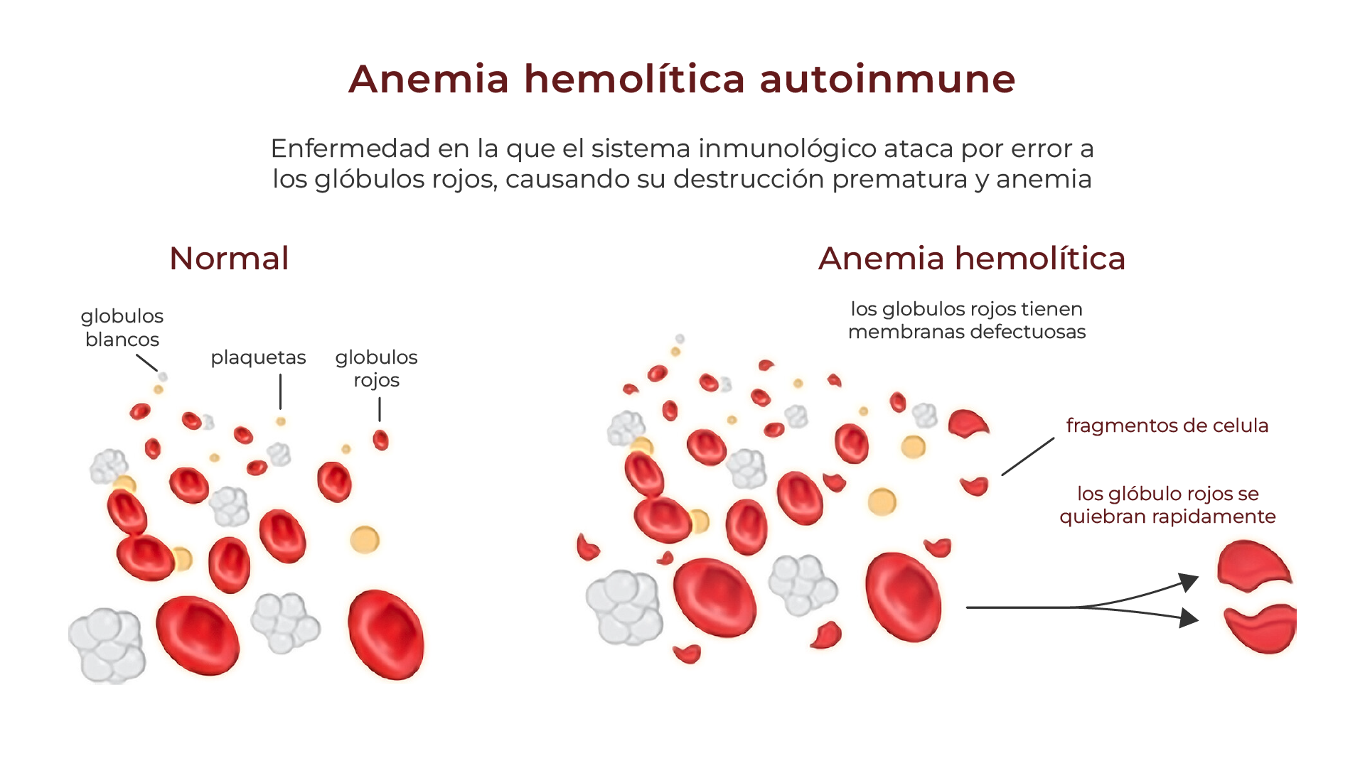 Anemia hemolítica autoinmune - Destrucción de glóbulos rojos por anticuerpos