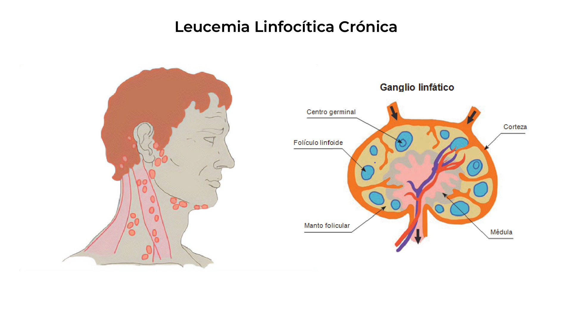 Comparación de conteo normal vs. anemia