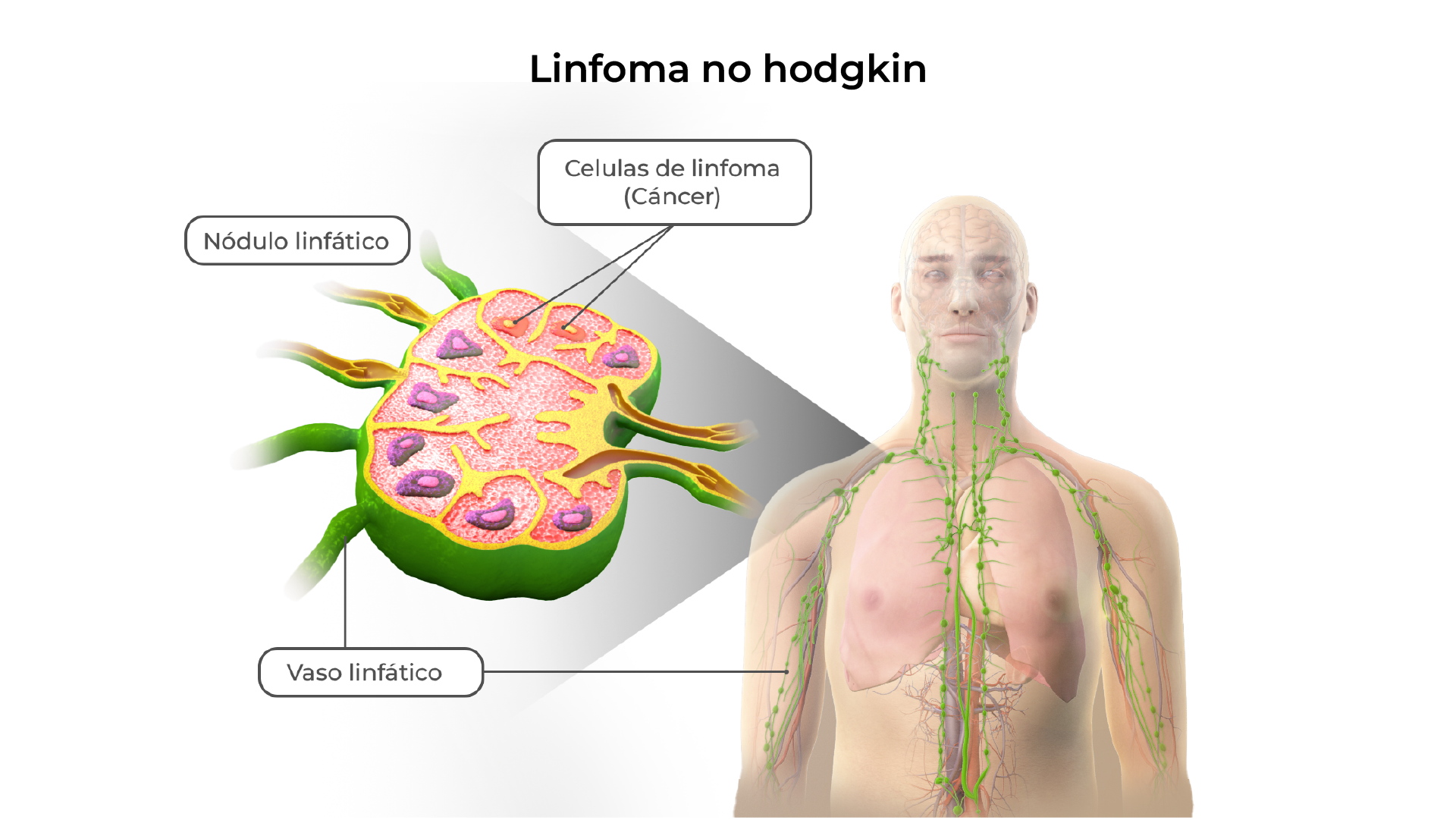 Comparación de conteo normal vs. linfoma no Hodgkin