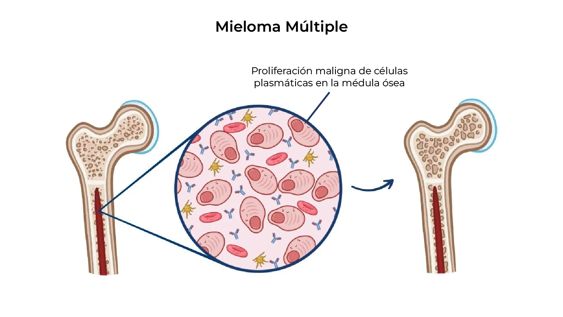 Comparación de conteo normal vs. anemia