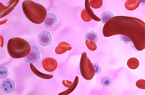 Anemia Hemolítica Autoinmune