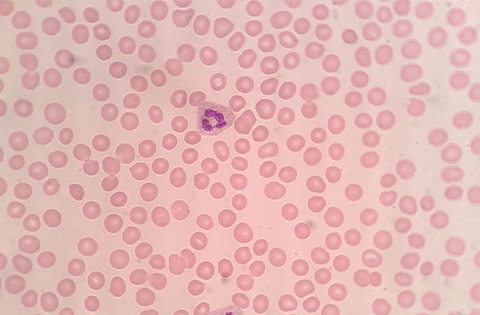 Púrpura trombocitopénica inmune (PTI)