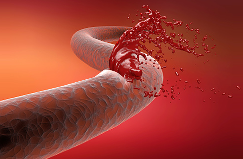 Trastornos hemorrágicos
