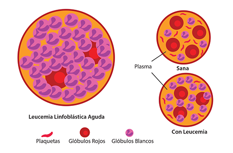 Leucemia linfoblástica aguda (LLA)
