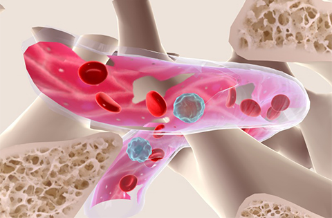 Síndromes mielodisplásicos (SMD)